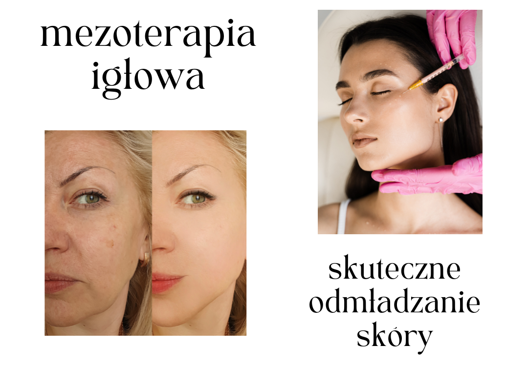 zabieg mezoterapii igłowej poprawia kondycję skóry twarzy i powoduje jej odmłodzenie